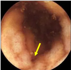 Fig. 1. Capsule endoscopic findings obtained 20 months earlier  before admission. Mild mucosal edema with hyperemia in the  terminal ileum (yellow arrow) suggested ischemic enteritis in the  recovery phase.