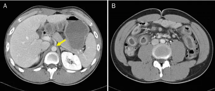 Fig. 2. Abdominal pelvic CT showing celiac trunk stenosis (A) (yellow arrow), diffuse wall thickening of the small bowel (B), which were suggestive of extensive ischemic enteritis.