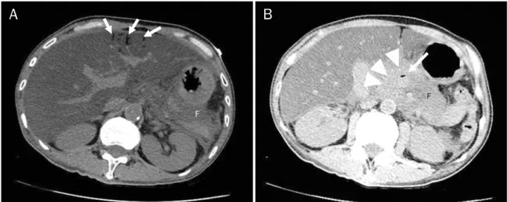 Fig. 1. Acute pancreatitis with portal and superior mesenteric venous gas. (A) CT showed portal vein air (arrows) in the peripheral portion of  left hepatic lobe