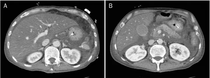 Fig. 2. Follow-up CT after 2 days. CT scans showed absence of air in the portal vein (A) and superior mesenteric vein (B)