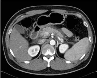 Fig. 1. Abdominal CT showed peripancreatic fat infiltration and the  collection of fluid around the pancreas.