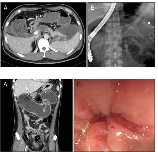Fig. 2. (A) Abdominal CT showed fluid  collection surrounded by enhanced  wall, suggesting psuedocyst