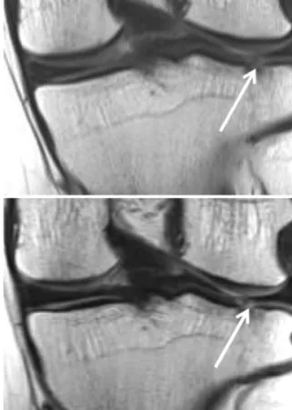 Figure 1. Coronal 3 tesla magnetic resonance images of knee in 69-year-old women show surgically confirmed  avul-sive tear of posterior root of medial meniscus