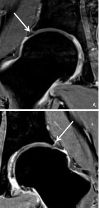 Figure 4. A 20-year-old man with healing process of subchon- subchon-dral insufficiency fracture at bilateral femoral heads.