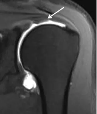Figure 5. A 53-year-old male patient with partial thickness tear of supraspinatus tendon