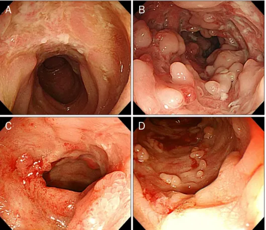 Fig. 1. Colonoscopic findings. (A, B)  Multiple longitudinal active ulcers  with cobblestone appearance and  luminal narrowing were seen in the  terminal ileum and ascending colon  at first diagnosis