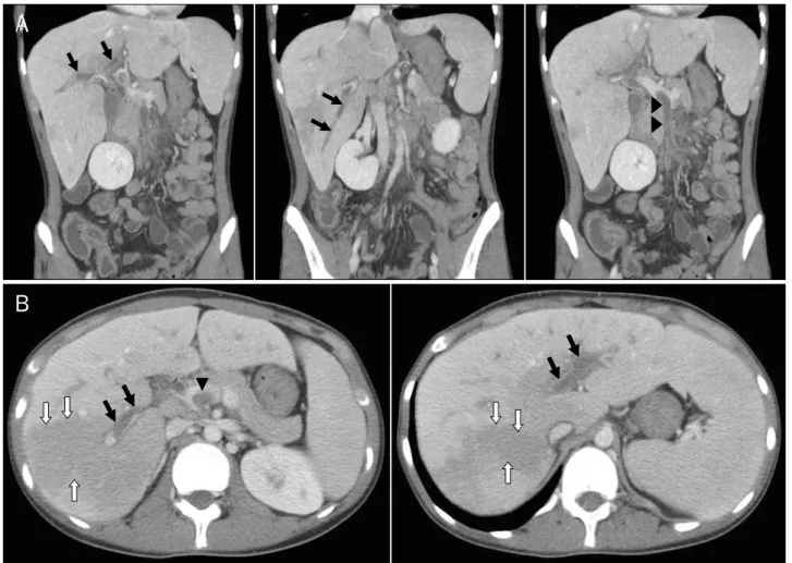 Fig. 2. Contrast-enhanced abdominal computed tomography findings. Multiple thromboses with periportal edema were seen in the right, middle,  left and main portal veins (black arrows)