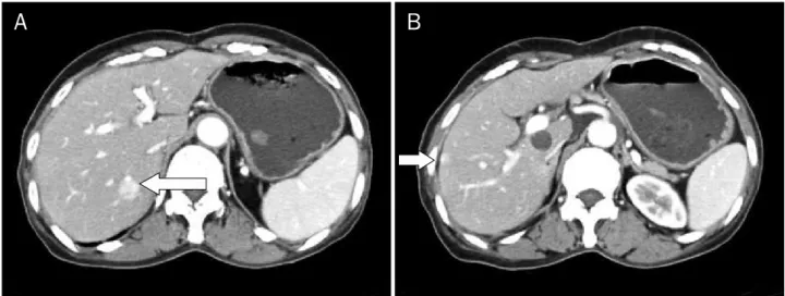 Fig. 1. A mass (6.3×5.1 cm; arrow) with multifocal low attenuation  areas was seen in the head of the pancreas at first visit.