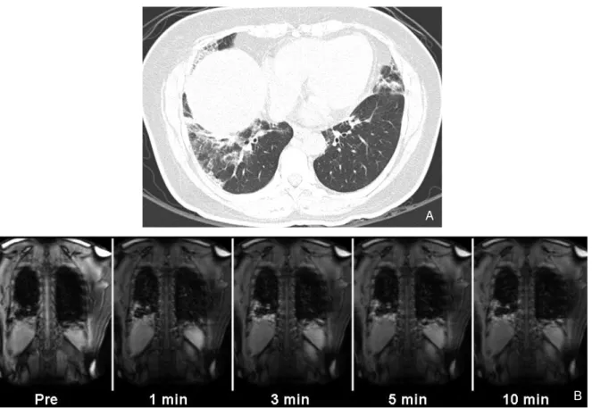 Figure 3.   A 55-year-old woman with nonspecific interstitial pneumonia (group 1, cellular) exhibiting early enhancement