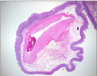 Fig. 2. Mesenteric angiography showed ectatic artery accompanied by contrast extravasation and staining (arrow) at the jejunum level.