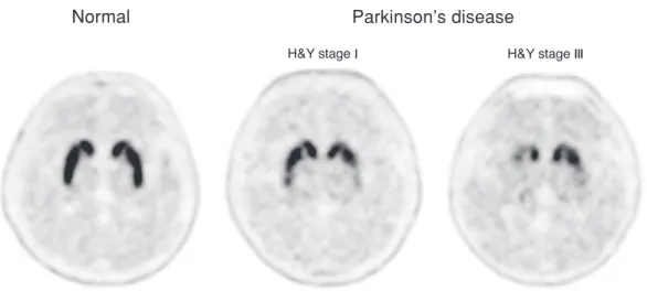 Figure 3. [ 18 F]FP-CIT PET images of normal healthy person and patients with early stage (H&amp;Y stage I) and advanced stage (H&amp;Y stage III) of Parkinson s disease