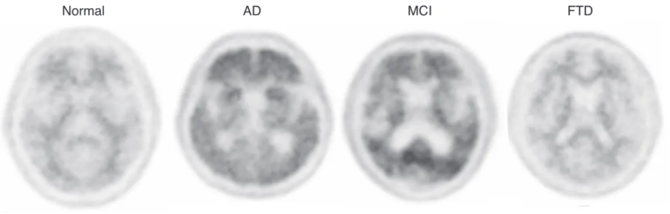 Figure 5.  [ 11 C]PIB PET images of normal healthy person and patients with Alzheimer s disease, Mild cognitive impairment, and frontotemporal dementia