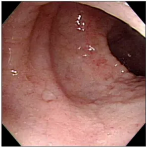 Fig. 1. Colonoscopic finding. Colonoscopy showed shallow ulceration at the terminal ileum.