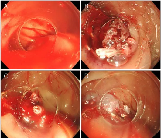 Fig. 1. Endoscopic findings. (A) Fresh duodenal bleeding after blood clot  removal. (B, C) Continuous bleeding  after clipping of the necrotized  mu-cous membrane