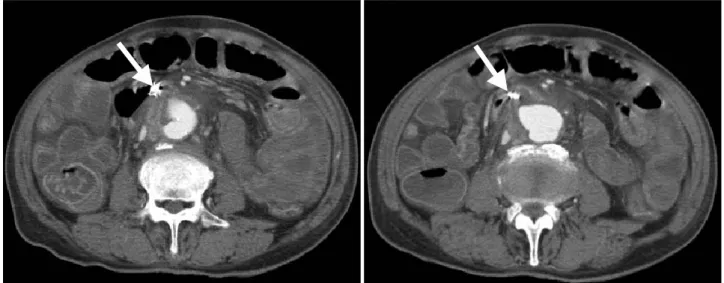 Fig. 3. Sagittal abdominal CT showing communications between the saccular abdominal aortic aneurysm of the abdominal aorta (lumbar levels  3-4) and the distal duodenum (arrow).