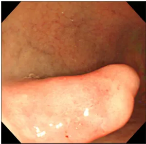 Fig. 1. Endoscopic finding. An elongated polypoid lesion with  hyperemia and erosion was seen at the anterior wall of the duodenal bulb.증례: 63세  여자  환자가  개인병원에서  시행한  상부위장관 내시경검사에서  십이지장에  용종형  병변이  발견되어  정밀  검사를  위해  내원하였다