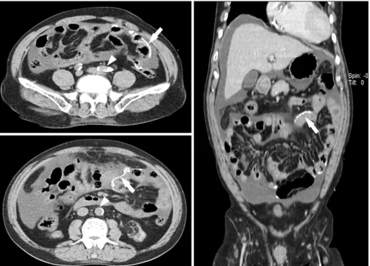 Fig. 3. Abdominal CT scan showed  linear calcification along jejunal wall  (arrows). Also, aortic calcification was also noted (arrowheads).