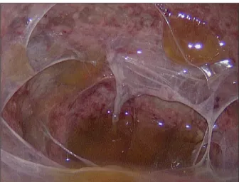 Fig. 2. Gross findings through the laparoscope. Diffuse whitish  nodules with ascites were noted on the peritoneum.