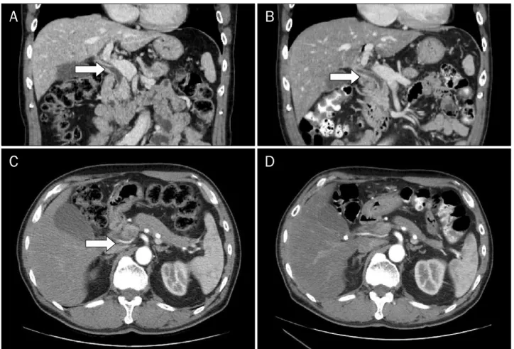 Fig. 1. Abdominal CT findings. (A) Initial coronal CT scan showed diffusely enhancing ductal wall which was thickened from the intrahepatic duct  to proximal common bile duct (arrow)