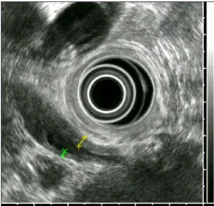 Fig. 3. ERCP findings. (A) Initial ERCP  cholangiogram demonstrated diffuse and relatively irregular stricture of the intrahepatic duct and common  hepa-tic duct