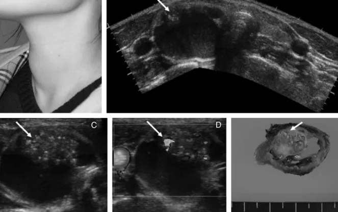 Figure 5. A case of mixed solid and cystic nodule with multple risky US features in solid portion