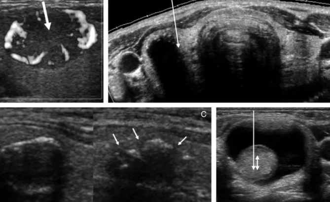 Figure 9. Some tricks for difficut US-FNA. 