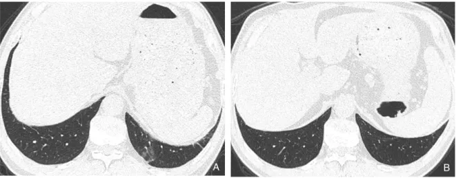 Figure 6. Dependent atelectasis in a patient with asbestos exposure. (A) In the supine HRCT, focal ill-defined ground-glass opacity (GGO) and short line are visible posteriorly