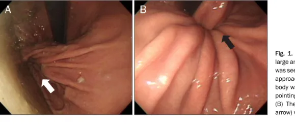 Fig. 1. Endoscopic findings. (A) The  large amount of gastric juice and food was seen in the stomach
