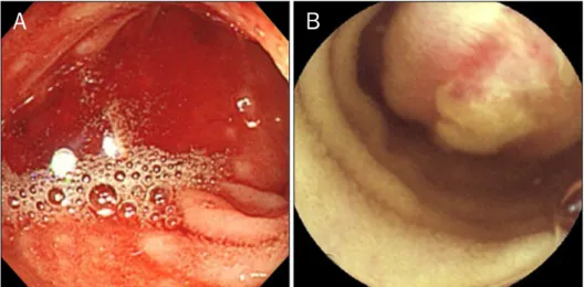 Fig. 1. (A) Fresh blood gushed out from above the terminal ileum. (B) Capsule endoscopy revealed a submucosal  lump with erosion located in the  jeju-num