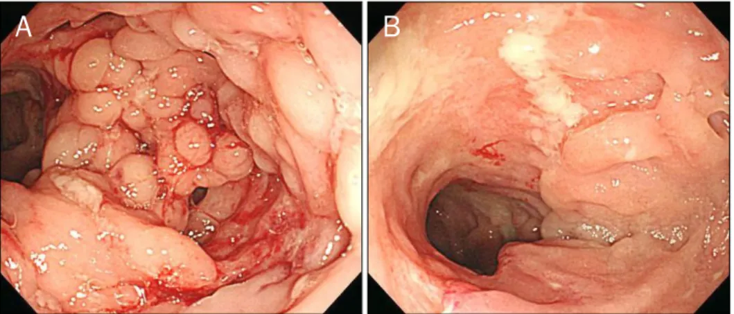Fig. 2. A small bowel follow-through at diagnosis demonstrating  multiple strictures and pseudosacculations (arrowhead, stricture; 