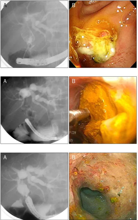 Fig. 3. (A) Direct cholangioscope was  inserted into the bile duct. (B)  Elec-trohydraulic lithotripy probe is seen  adjacent to the stone.