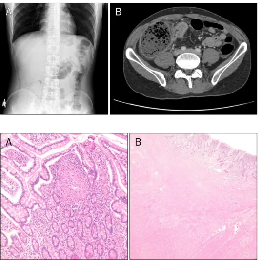 Fig. 1. X-ray (A) and CT finding (B) of a patient in non-responder group.