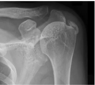 Figure 9.  Rotator cuff tear seen from arthroscopic camera.