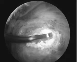 Figure 15.  Repair of the supraspinatus tendon after removal of the calcific deposit.
