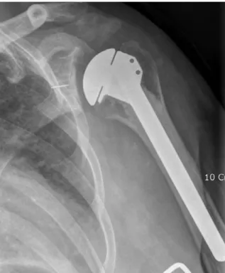 Figure 16.  Simple X-ray of shoulder osteoarthritis.