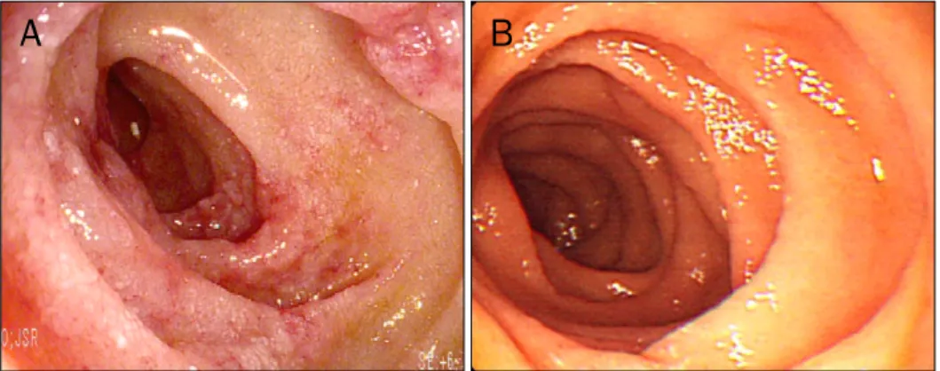 Fig. 1. Esophagogastroduodenosco- Esophagogastroduodenosco-pic findings of duodenum. They  showed (A) diffuse edematous and  whitish mucosa with multiple  ero-sions initially, and (B) nearly complete  resolution of the diffuse mucosal  lesions after viral 