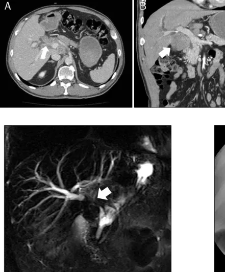 Fig. 1. (A, B) Contrast-enhanced CT  image shows a diffusely infiltrating  soft- tissue mass at the hilum (arrows) that extends along the gallbladder  neck and cystic duct.