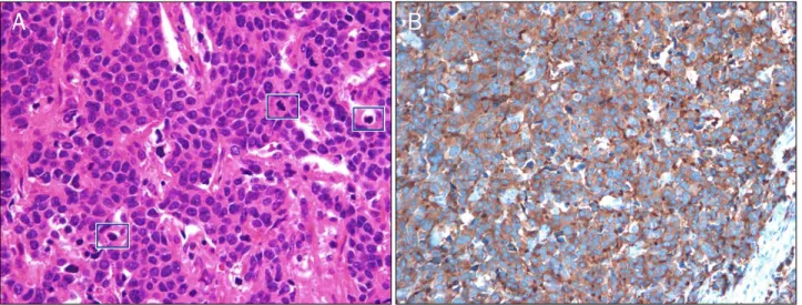 Fig. 4. Histopathological findings. (A) The tumor cells are composed predominantly of small to medium-sized round or oval cells with  hyperchromatic nuclei, inconspicuous nucleoli, and scanty cytoplasm (H&amp;E, ×400)