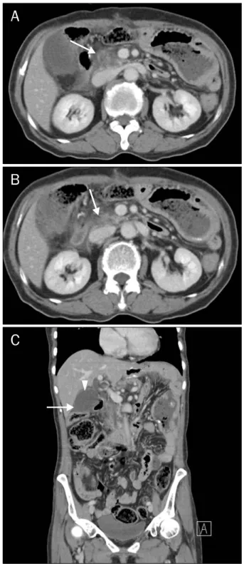 Fig. 1. Abdominal computed tomography. (A) Enlarged uncinate  process with irregular low density from edema was noted (arrow)