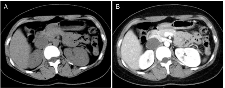 Fig. 1. Initial CT scan. (A) Pre-enhance axial image shows 3.7 cm sized cystic mass without solid component