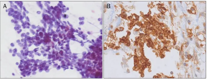 Fig. 3. (A) Microscopic finding of ultrasound guided biopsy shows small round neoplastic cells with irregular nuclei and sparse cytoplasm (H&amp;E,