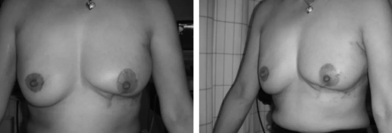 Figure 2E. Postoperative front and oblique views of thoracoepigastric flap after three months