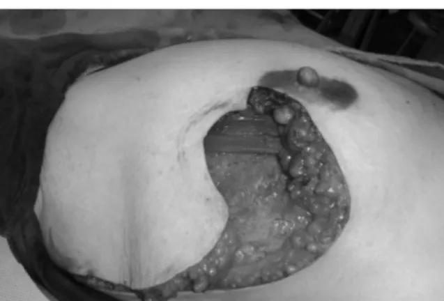 Figure 3C. Immediate postoperative view showing skin closure and completion of  rotational flap.