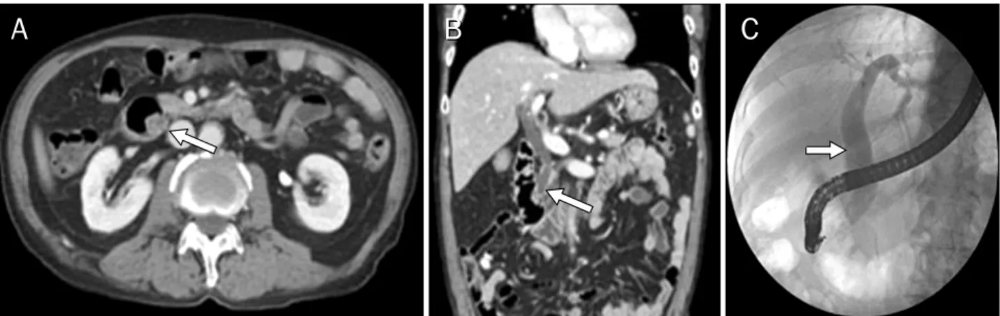 Fig. 1. Radiologic findings of adenomyomas in the ampulla of Vater. Abdominal CT (A, axial view; B, coronal view) showed a 1.4-cm mass  protruding into the duodenal lumen with a dilated common bile duct (arrows)