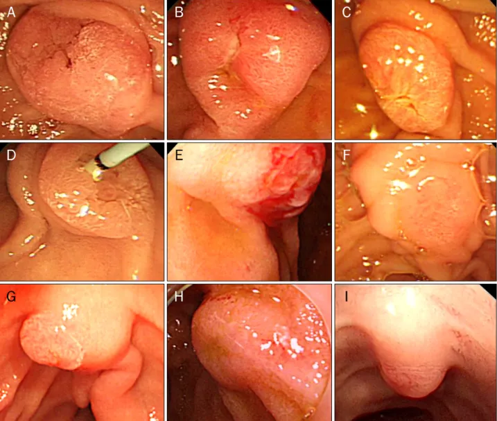 Fig. 2. Endoscopic view of ampullary adenomyomas. Enlarged major papilla and villous and granular mucosa around the papillary orifice could be identified in all cases; each case matched from A to I.
