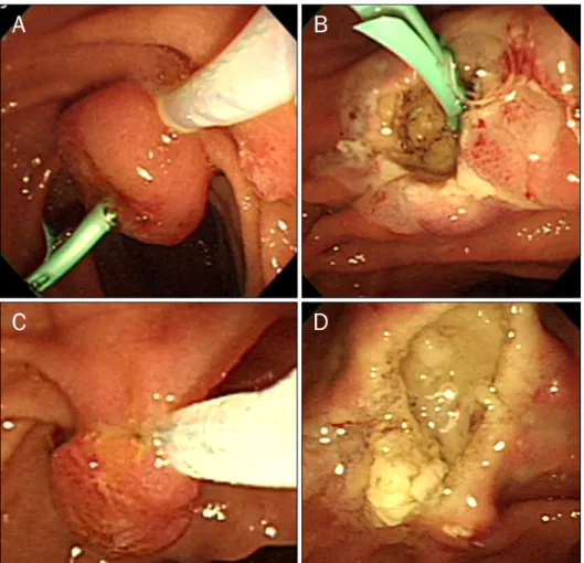 Fig. 4. Endoscopic papillectomy for an ampullary adenomyoma. (A)  Endos-copic papillectomy was performed  after pancreatic stent insertion