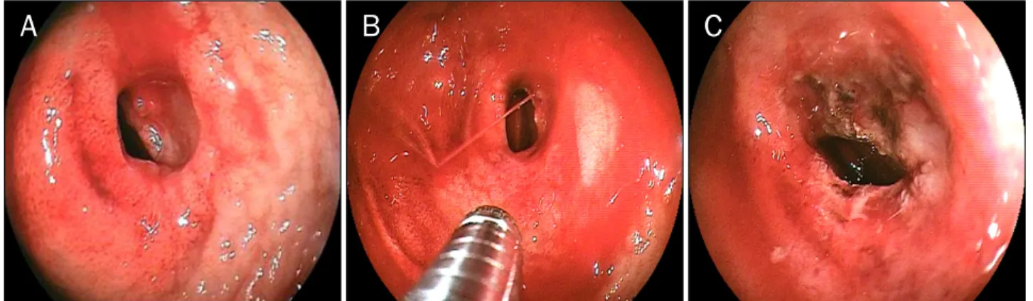 Fig. 2. (A, B) Double balloon endoscopy shows active ulcer with luminal stricture. Arterial spurting was noted at the ulcer base