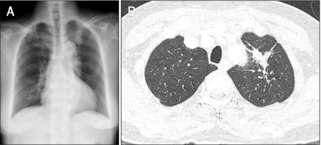 Fig. 1. (A) Chest X-ray shows increased nodular opacity in left upper lobe. (B)  Chest CT reveals a 4-cm-sized  irregu-lar low attenuated consolidative lesion in left upper lobe.