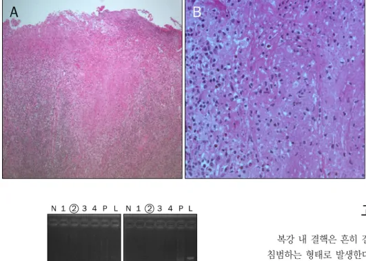 Fig. 3. Histopathologic findings of the  resected gallbladder (H&amp;E). (A)  Necro-tic change is seen on the resected  gallbladder mucosa (×100)