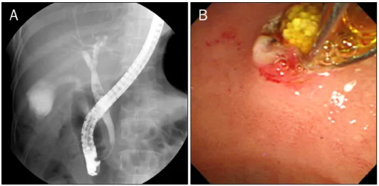 Fig. 4. Endoscopic retrograde cholan- cholan-giopancreatography. (A) Multiple stones are seen in the common bile duct, (B)  which proved to be yellowish  chole-sterol stones upon extraction by  basket